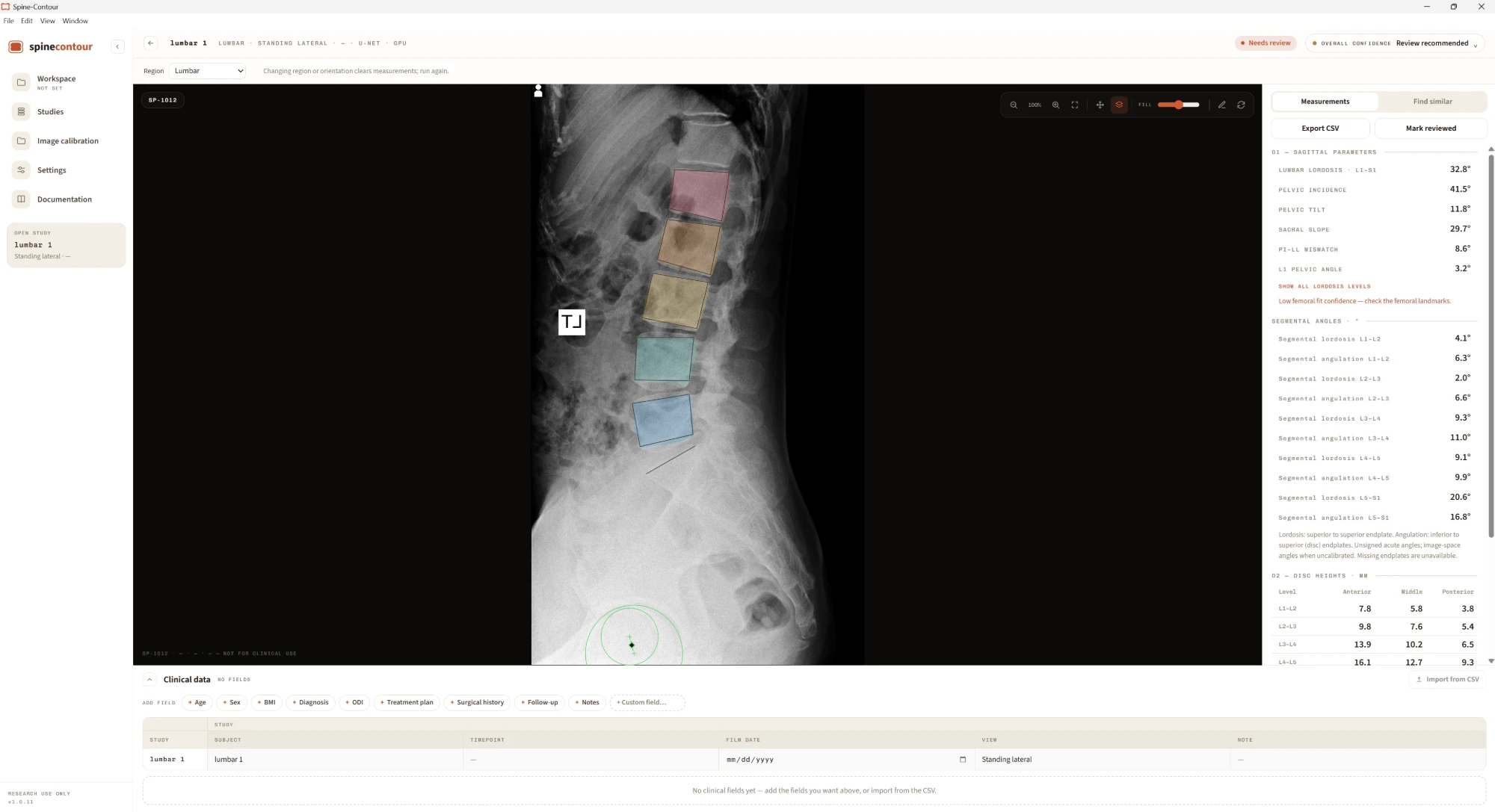 SpineContour study analysis of a standing lateral lumbar film: coloured outlines on L1 to L5, femoral head circles, and the measurements panel with sagittal parameters, segmental angles and disc heights